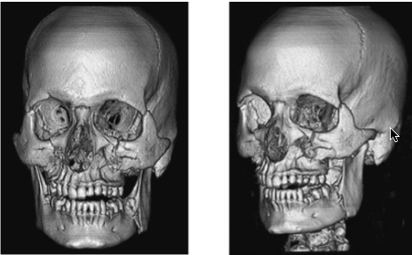 3D imaging fractures